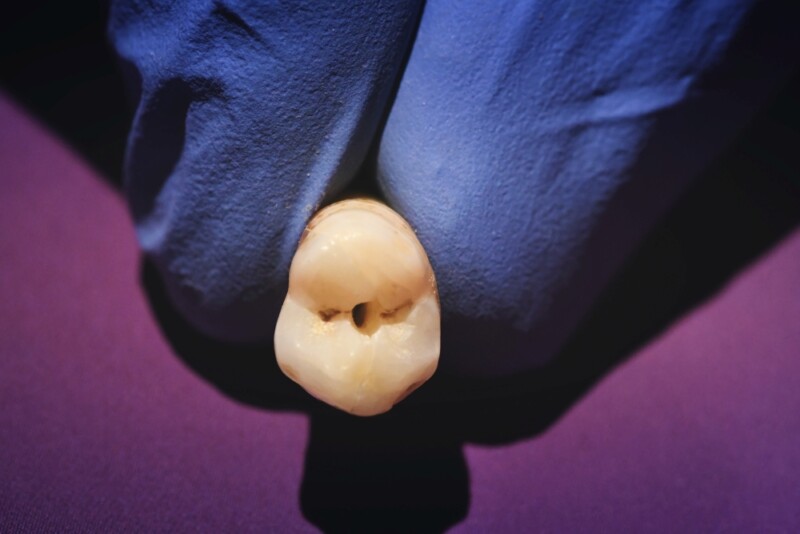 EN(DO)GINEERING Planowanie i przeprowadzanie procedur endodontycznych a biomechanika zęba