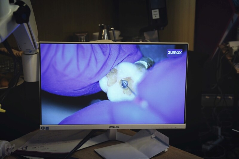 EN(DO)GINEERING Planowanie i przeprowadzanie procedur endodontycznych a biomechanika zęba